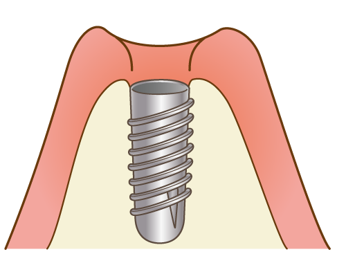 インプラント埋入手術のイメージ