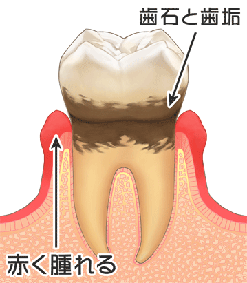 軽度歯周炎のイラスト