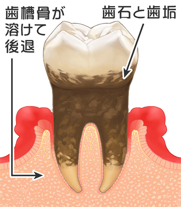 中等度歯周炎のイラスト