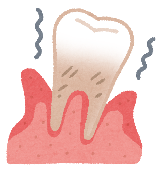 重度歯周炎の治療法